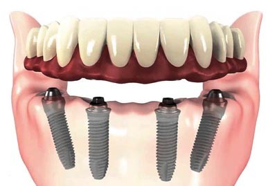 Okotoks All On Four Dental Implants
