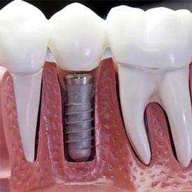 dental-implants-featured
