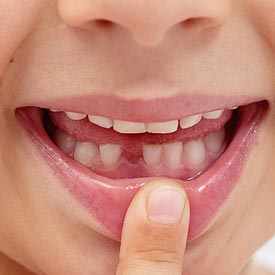 Okotoks Tooth Extraction | Cornerstone Dental