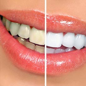 Okotoks Teeth Whitening